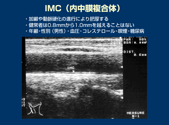 頚動脈超音波検査の有用性