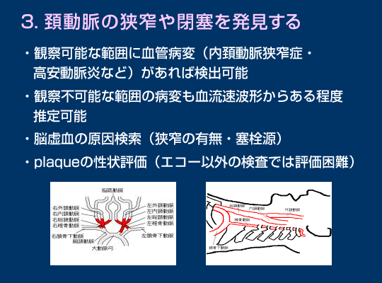 頚動脈超音波検査の有用性