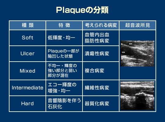 頚動脈超音波検査の有用性